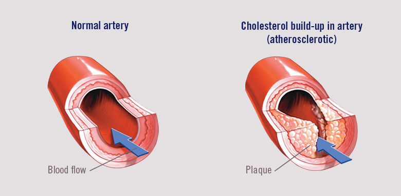 Cholesterol build-up in artery