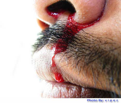 Nose bleeding